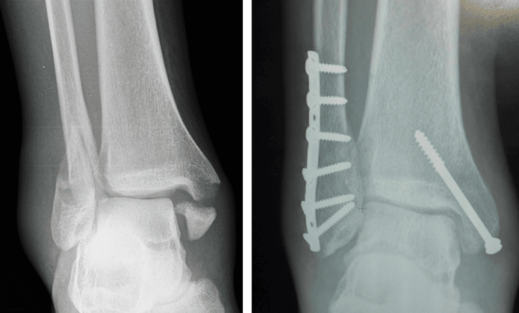 side by side xrays of a broken ankle and the same one stabilized with hardware.